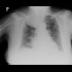 Neurofibroma of the thorax: X-ray - Plain radiograph